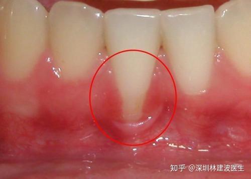 牙根为什么暴露出来了有什么补救的办法吗