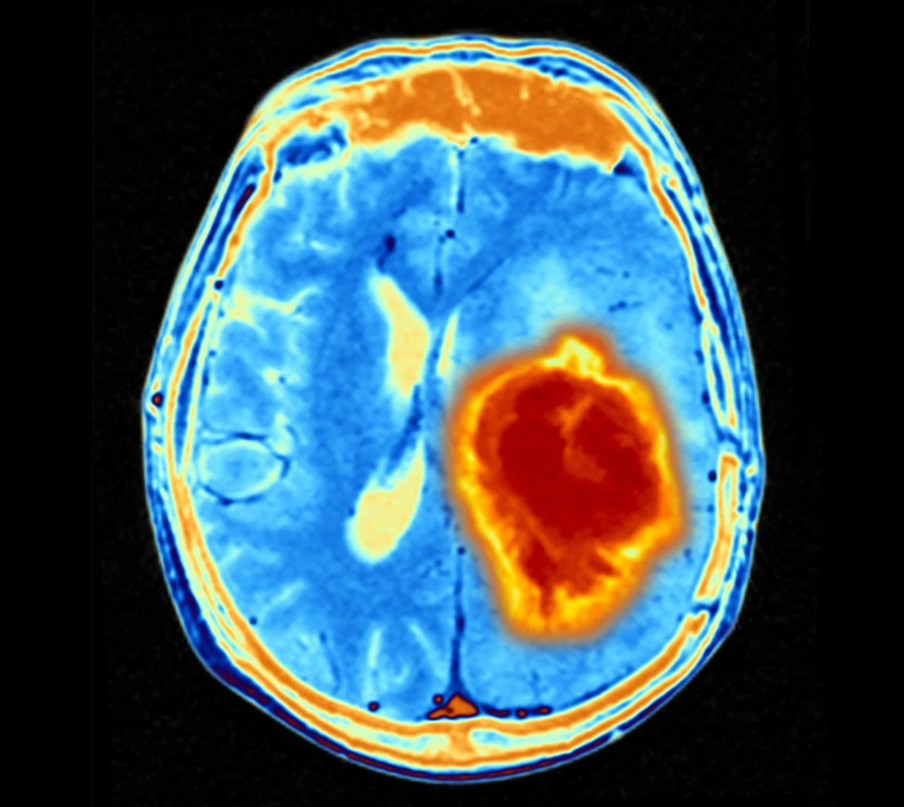 natcancer胶质母细胞瘤与创伤后的脑部愈合有关