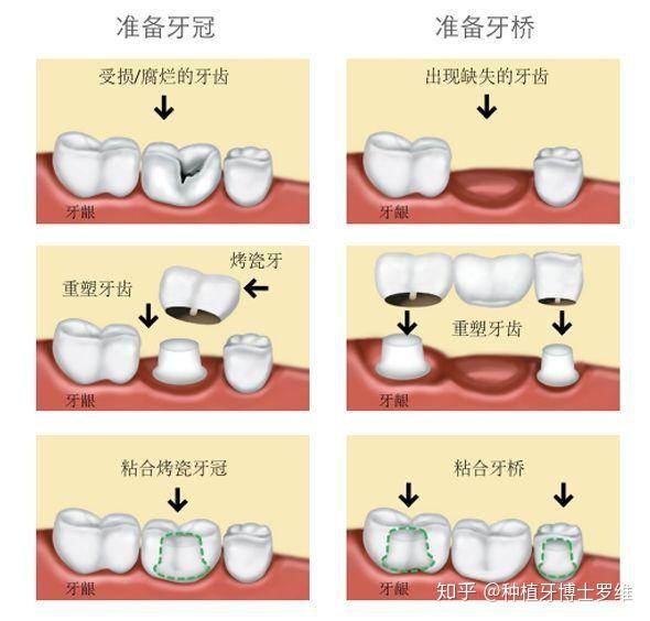 1,避免吃坚硬的食物即使完成根管治疗,牙齿恢复正常的咀嚼功能,但失去