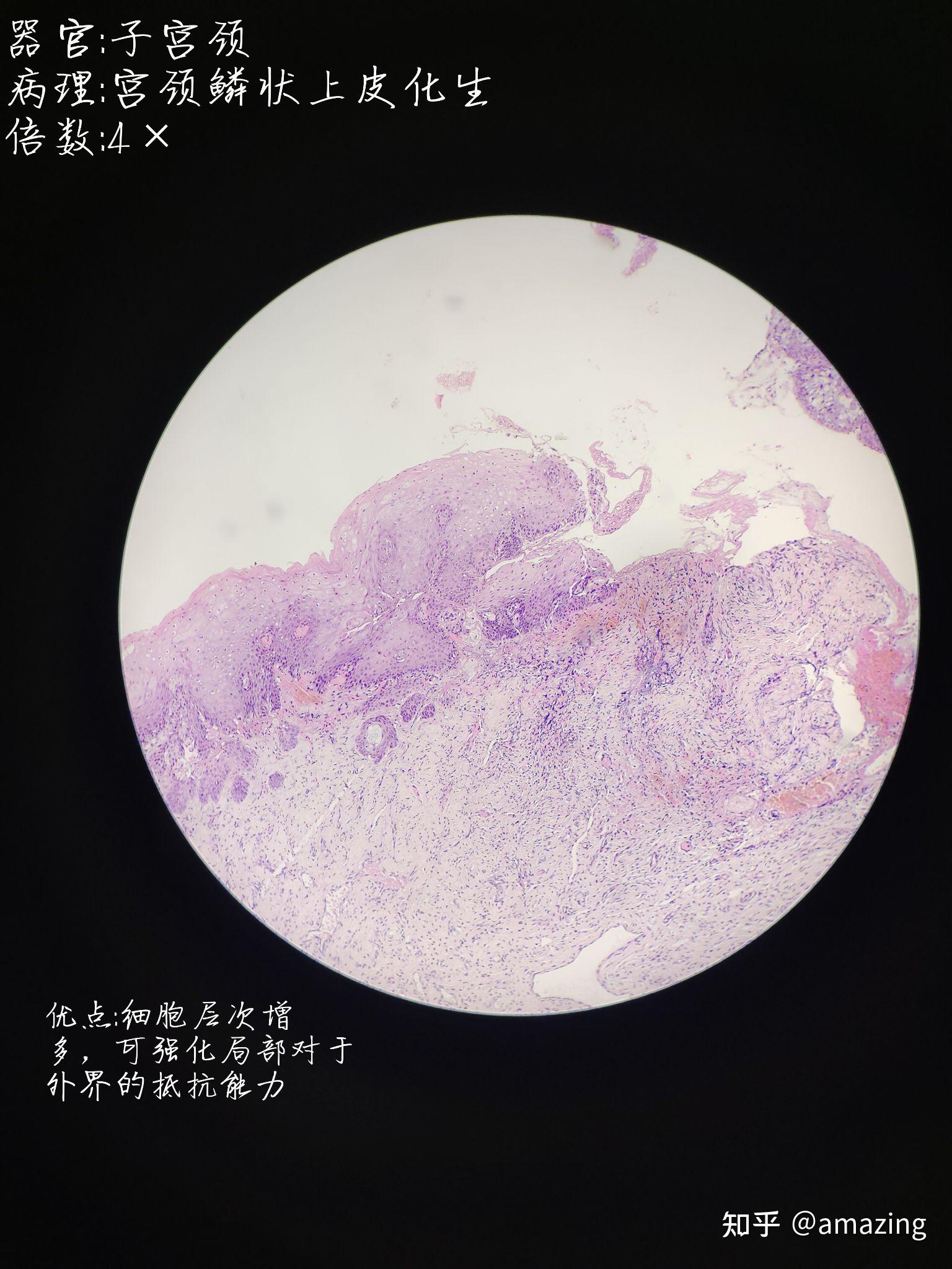 其深部的腺体也会发生化生,宫颈既可发生鳞化也可发生柱化,这个具体的