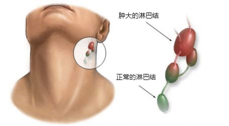 virchow淋巴结图片