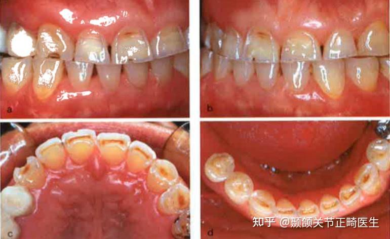 夜磨牙会引起的颞下颌关节损伤吗