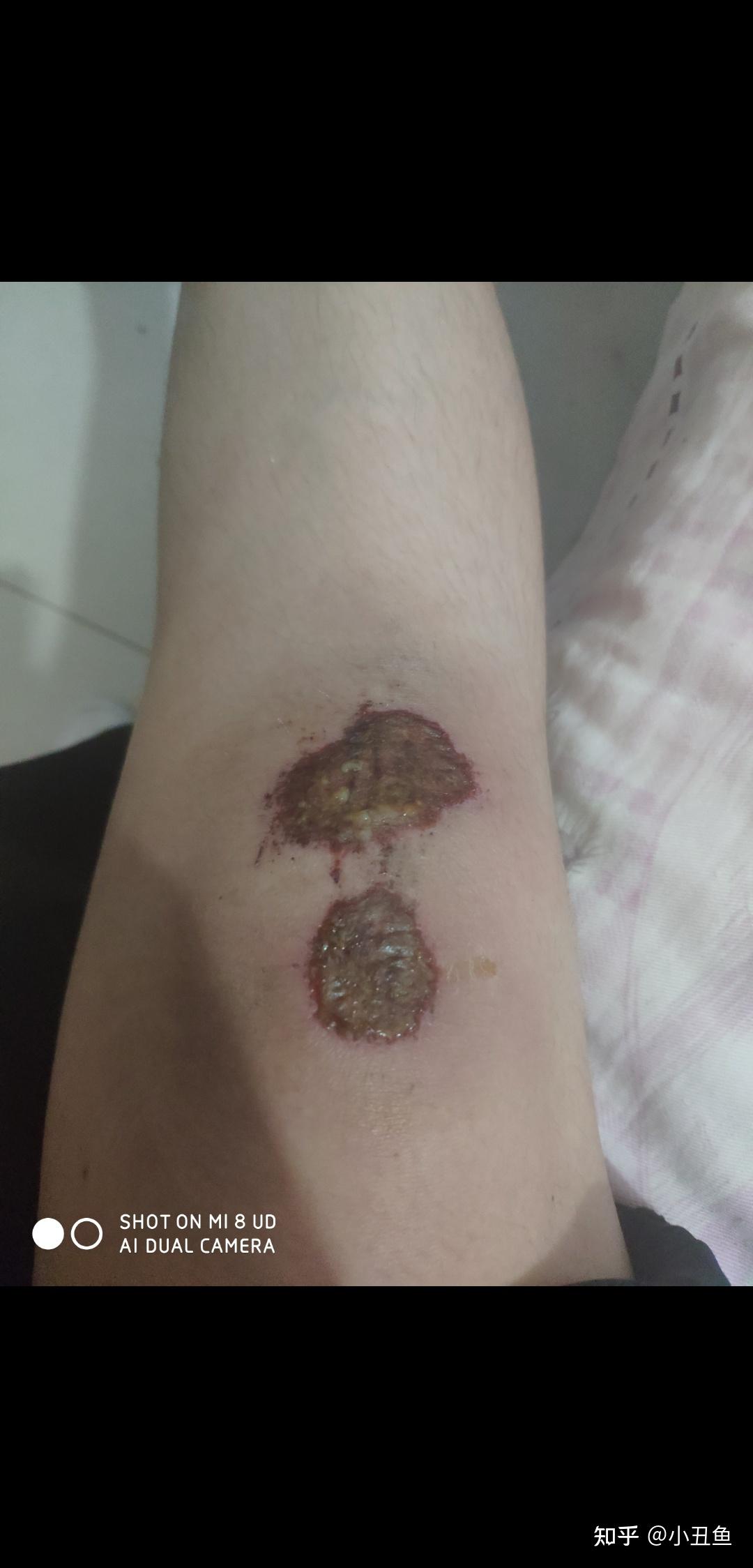 摔伤疤痕皮炎所治疗过程