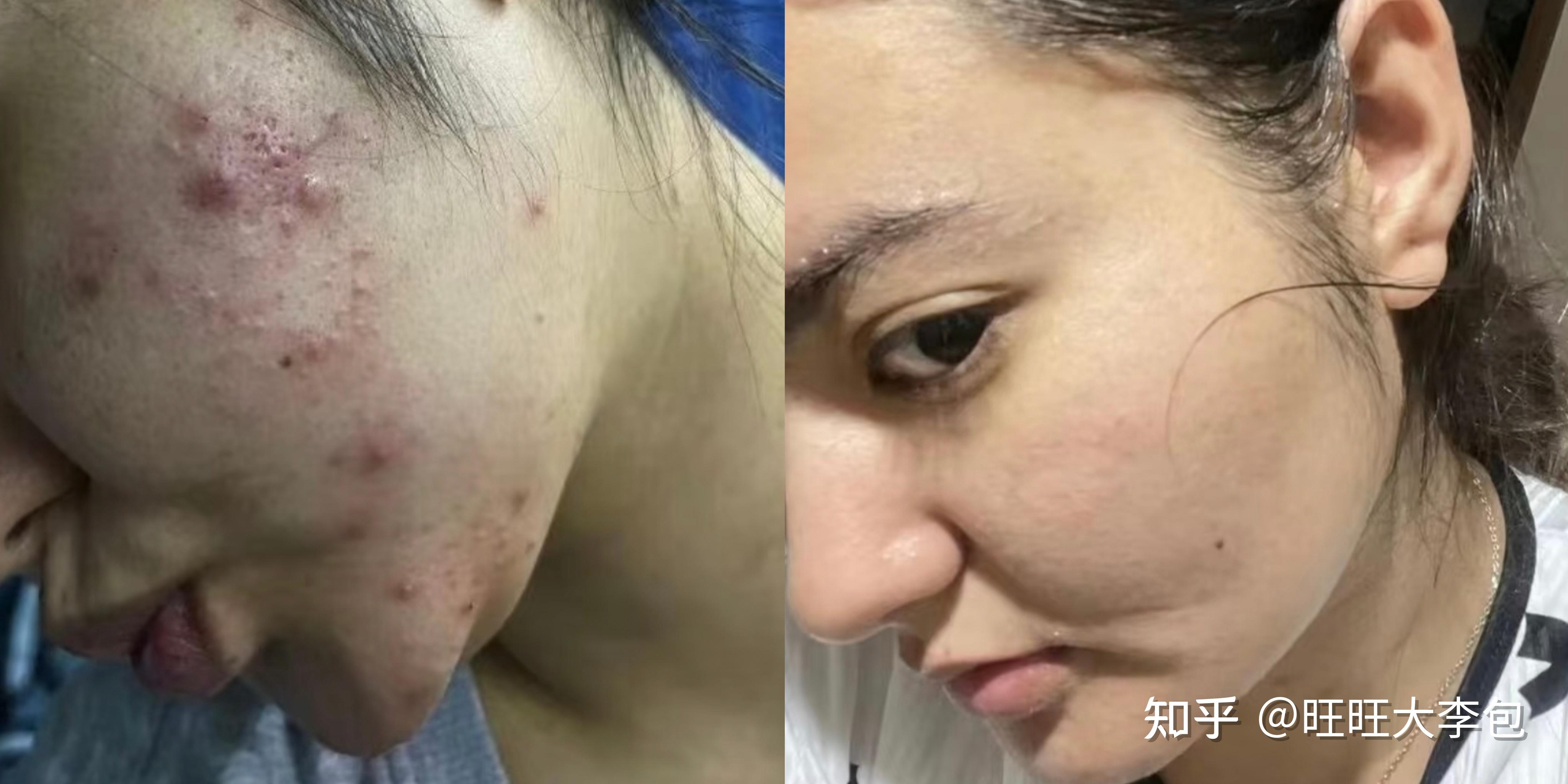 用针把痘痘弄破,会好吗? - 知乎