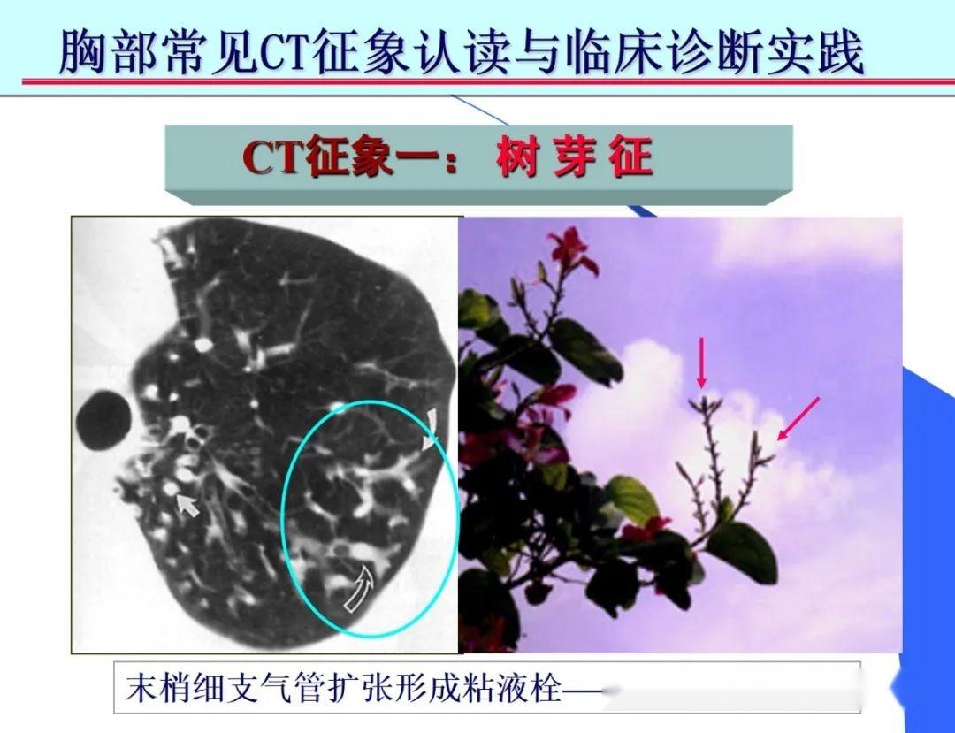 胸部CT读片技巧汇总 - 知乎