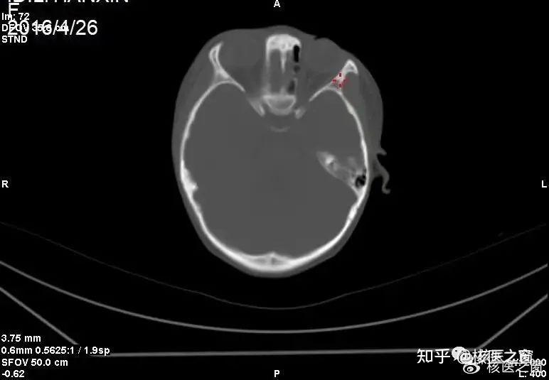 SPECT/CT图像融合技术的应用 - 知乎