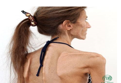 为了减肥彻底拼命了极端减肥法瘦成竹竿毁所有