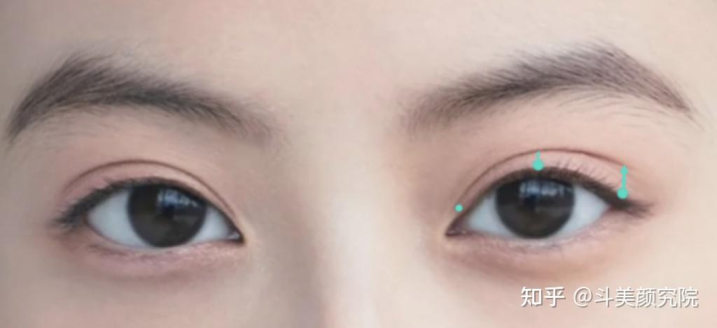 减龄又好看的教科书式双眼皮模板——广尾型双眼皮!