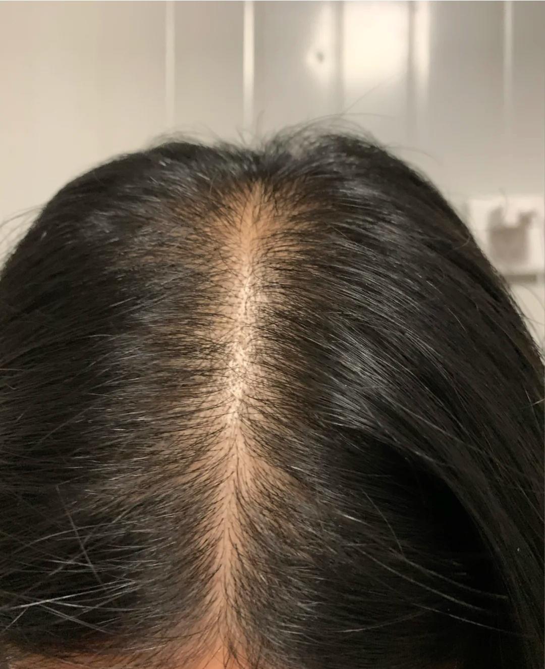 发量少的女生怎么才能增加发量? - 知乎