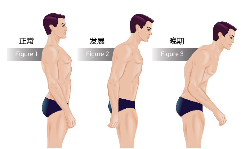 人驼背和龟背区别图图片