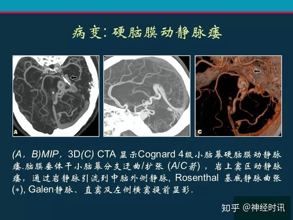 顱腦靜脈系統cta解剖病理陷阱