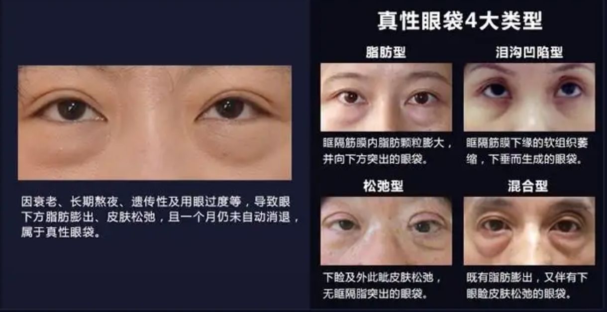 割眼袋哪种手术方式好内切外切眶隔释放去眼袋优缺点价格全面对比