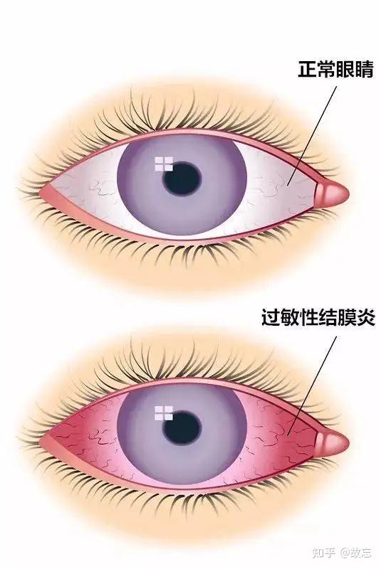 慢性结膜炎怎么治疗图片