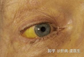 5,黄疸