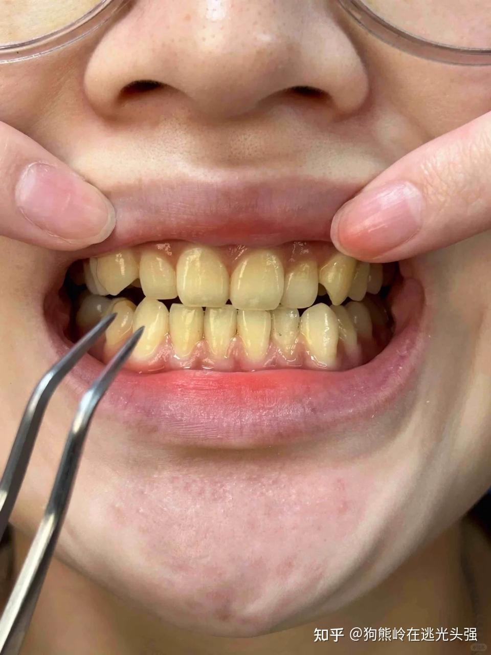 为什么天天刷牙, 牙齿还是很黄,还伴随着口臭?