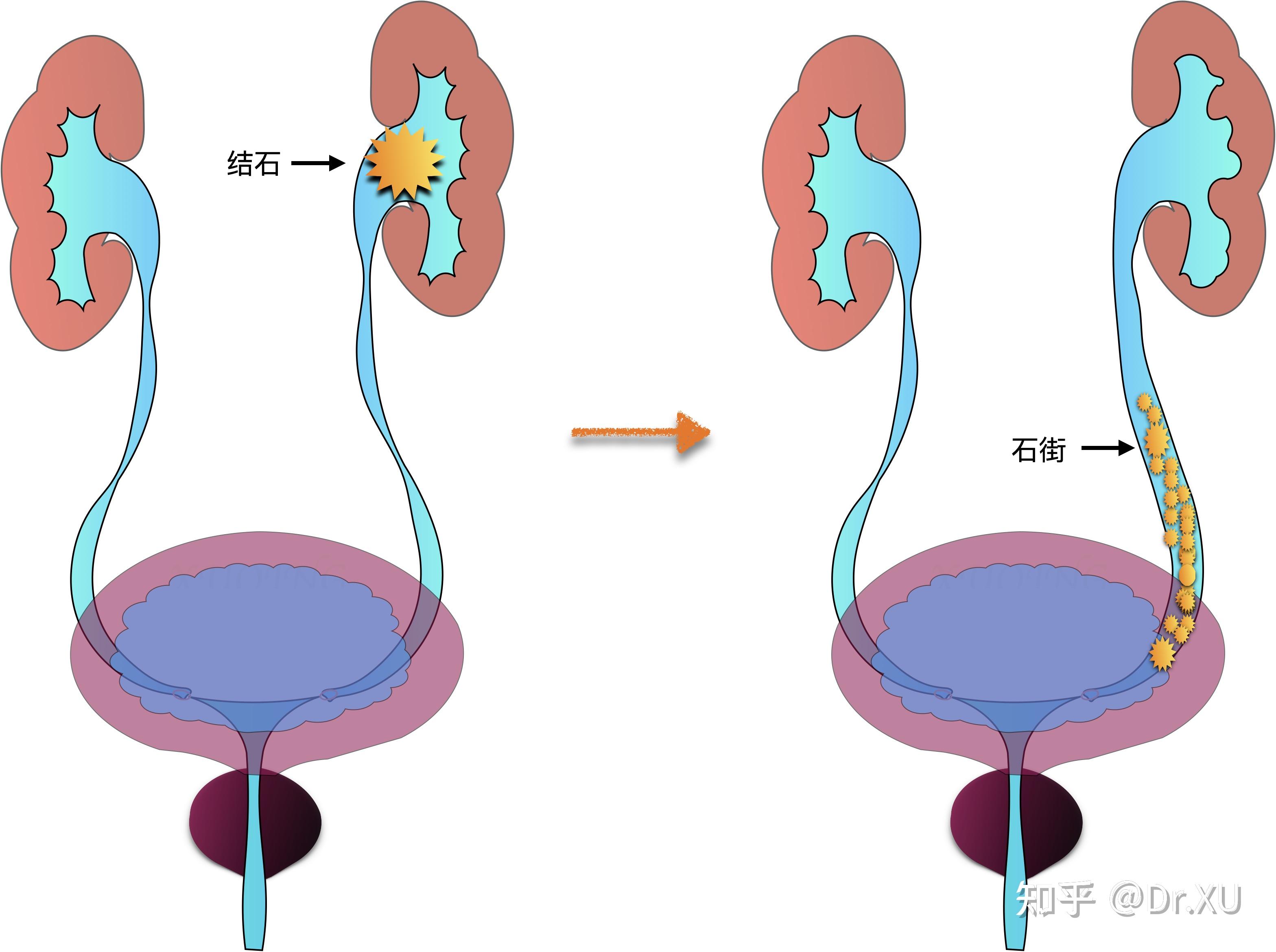 结石从膀胱到尿道图片图片