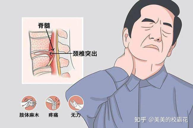 頸椎病怎麼緩解