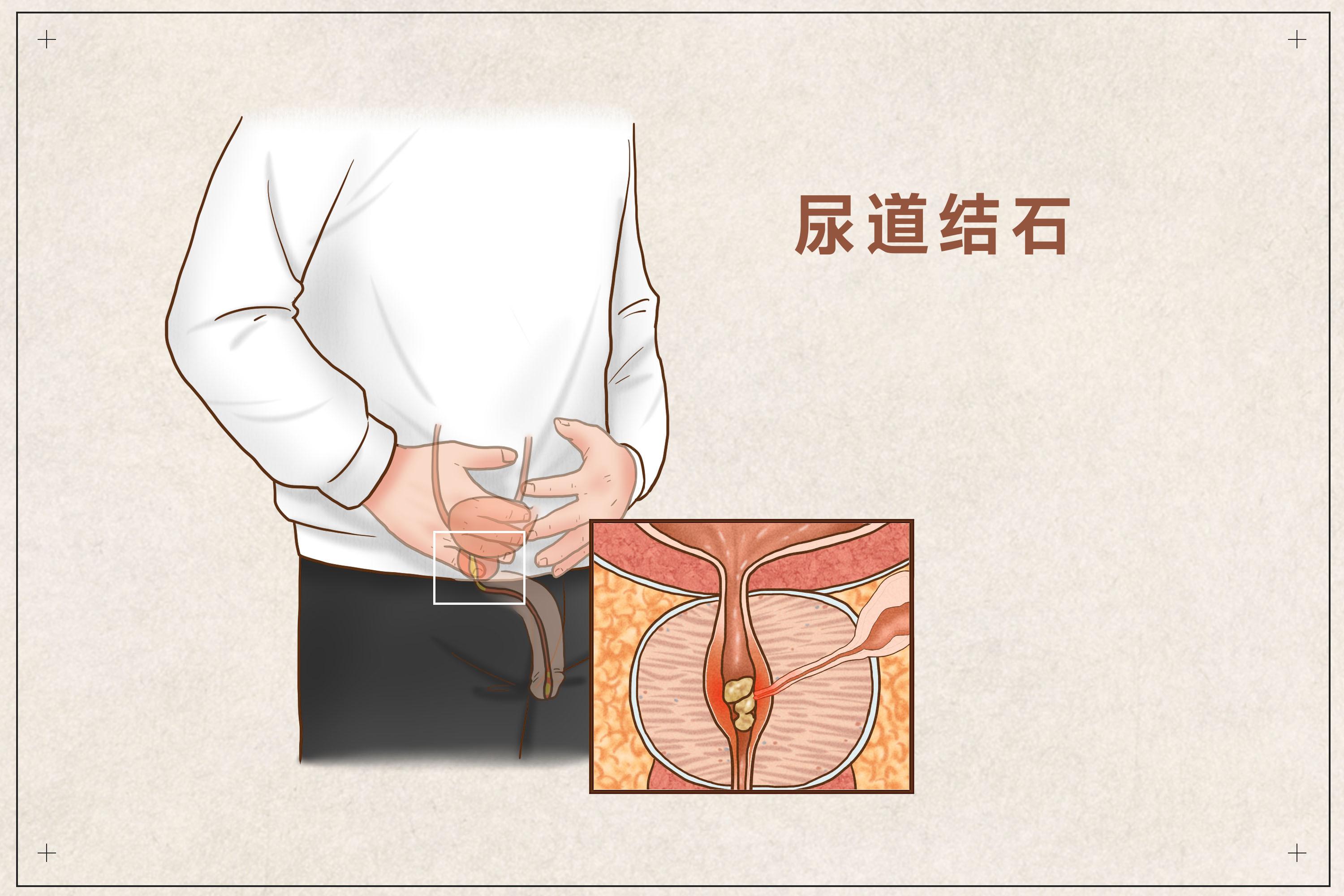 女性肾结石疼痛部位图图片