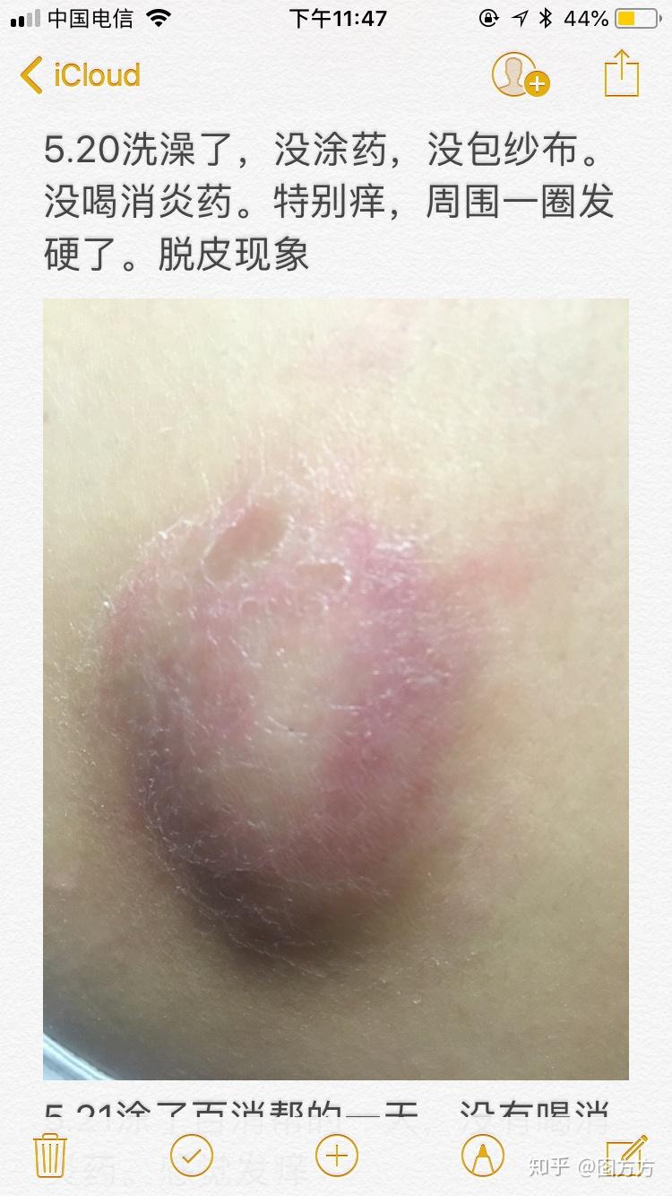 原来我长的不是疖子而是皮脂腺囊肿又称粉瘤 - 知乎
