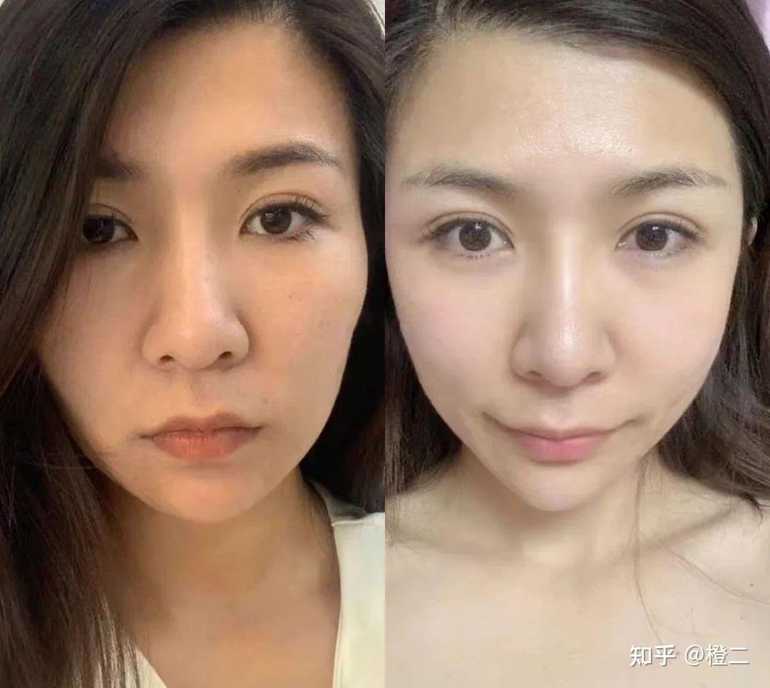 面部脂肪填充可以维持多久?不同部位应该怎么填?如何避免馒化后遗症?