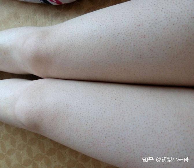 儿童鸡皮肤全身都是(儿童鸡皮肤怎么消除最有效的方法)