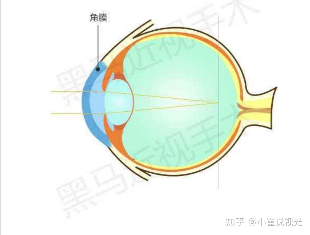 不同的近视程度，不同的眼中世界 - 易视眼科医院 · 荣昌【官网】-专业的眼科连锁机构