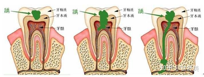牙髓炎是由于龋齿(蛀牙)造成牙齿表面坚硬的牙釉质被细菌产生的酸腐蚀
