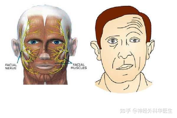 了解面肌痉挛的正确方法,才能走出治疗误区 - 知乎