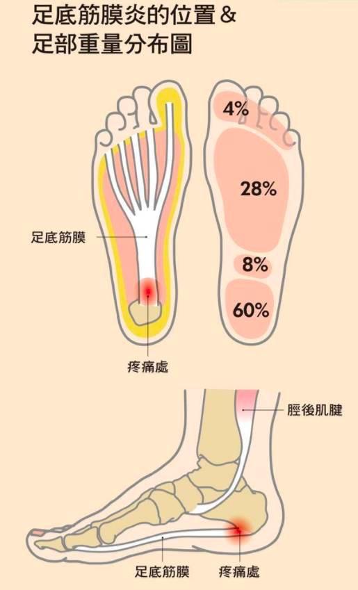 如何3招破解足底筋膜炎 知乎