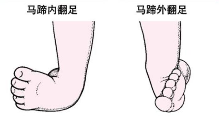 有思骨科普:聊聊【小朋友的足内翻、足外翻】 - 知乎