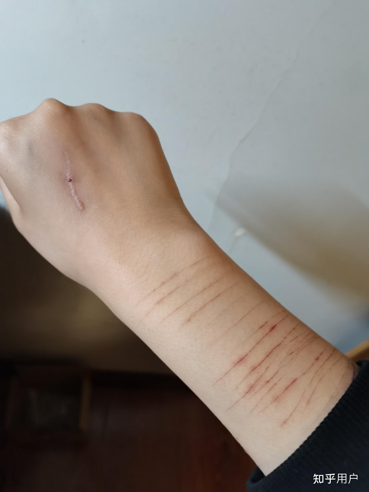 怎么遮自残的伤疤