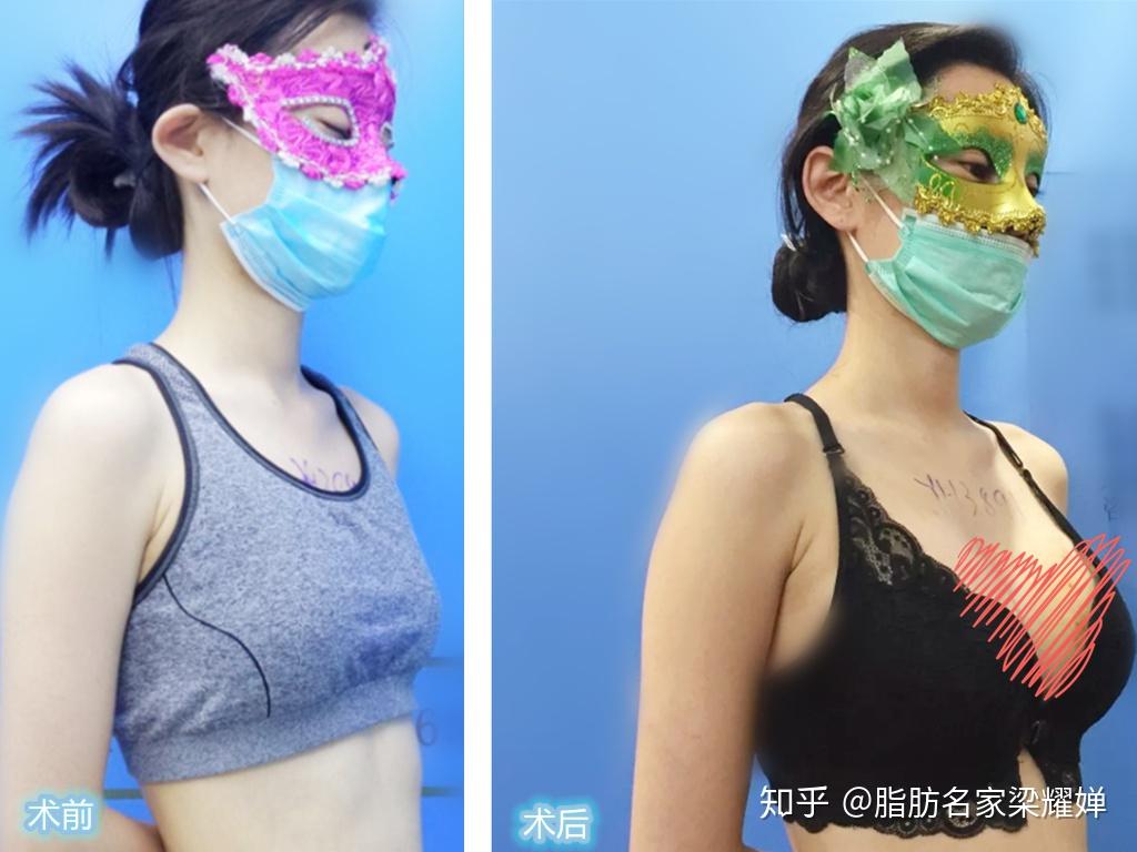 假体隆胸腋窝、乳晕、乳房下皱襞切口怎么选？优缺点分别是什么？怎么查询全国擅长假体隆胸的医生？