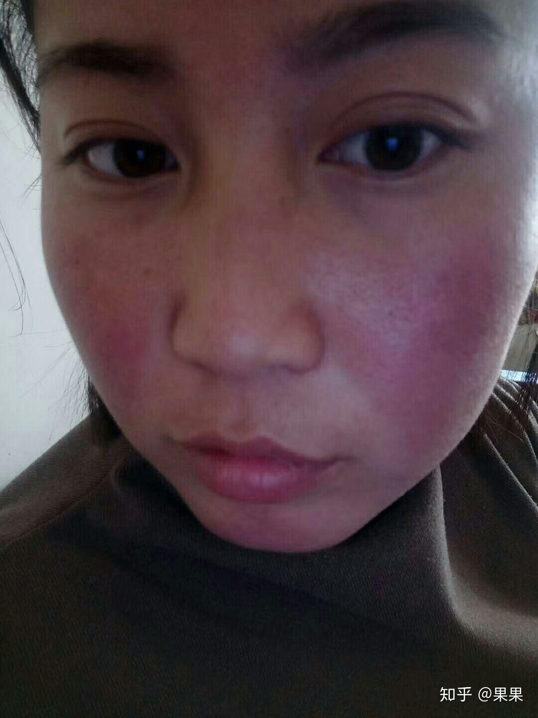 我是高敏肌肤用洗面奶特别容易过敏有没有什么好的敏感肌用的洗面奶