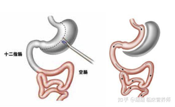 减肥手术有什么危害_手术减肥_减肥手术医保能不能报销