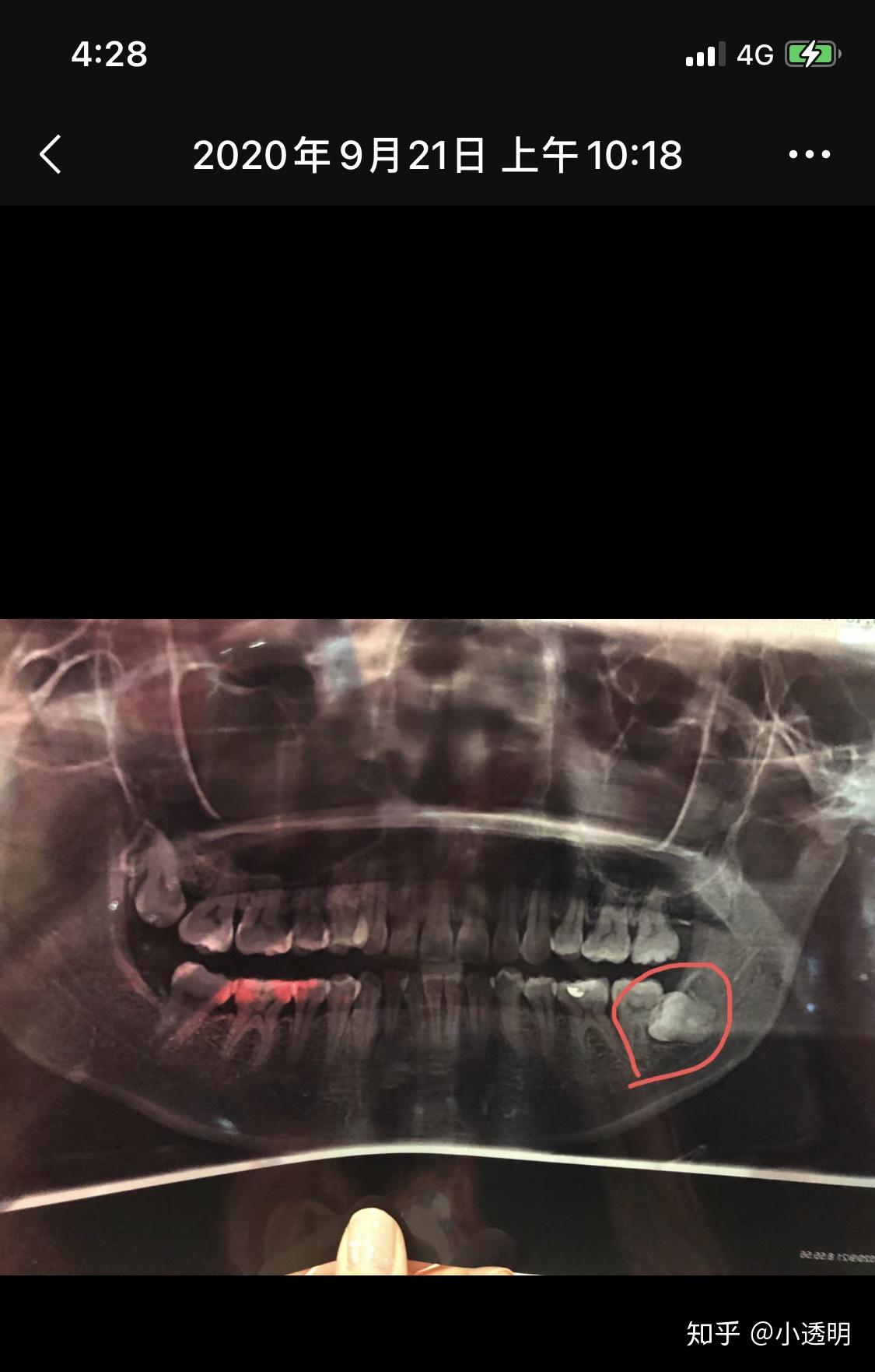 拔智齿伤到下颚神经嘴麻下巴麻牙齿麻