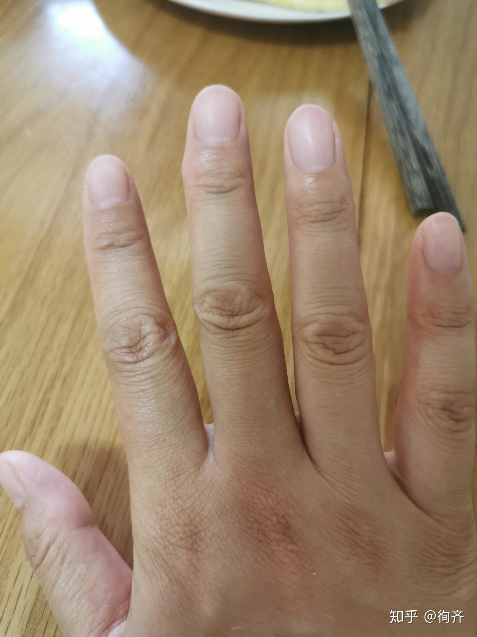 长期错误握笔导致中指有肿块要如何去除