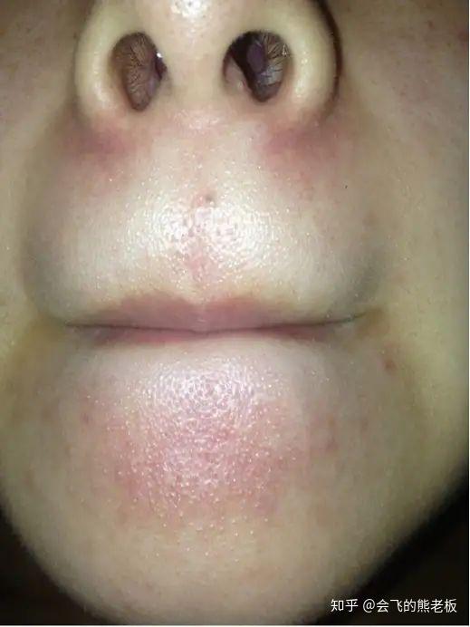 而毛孔受污物阻塞时,毛囊容易发炎