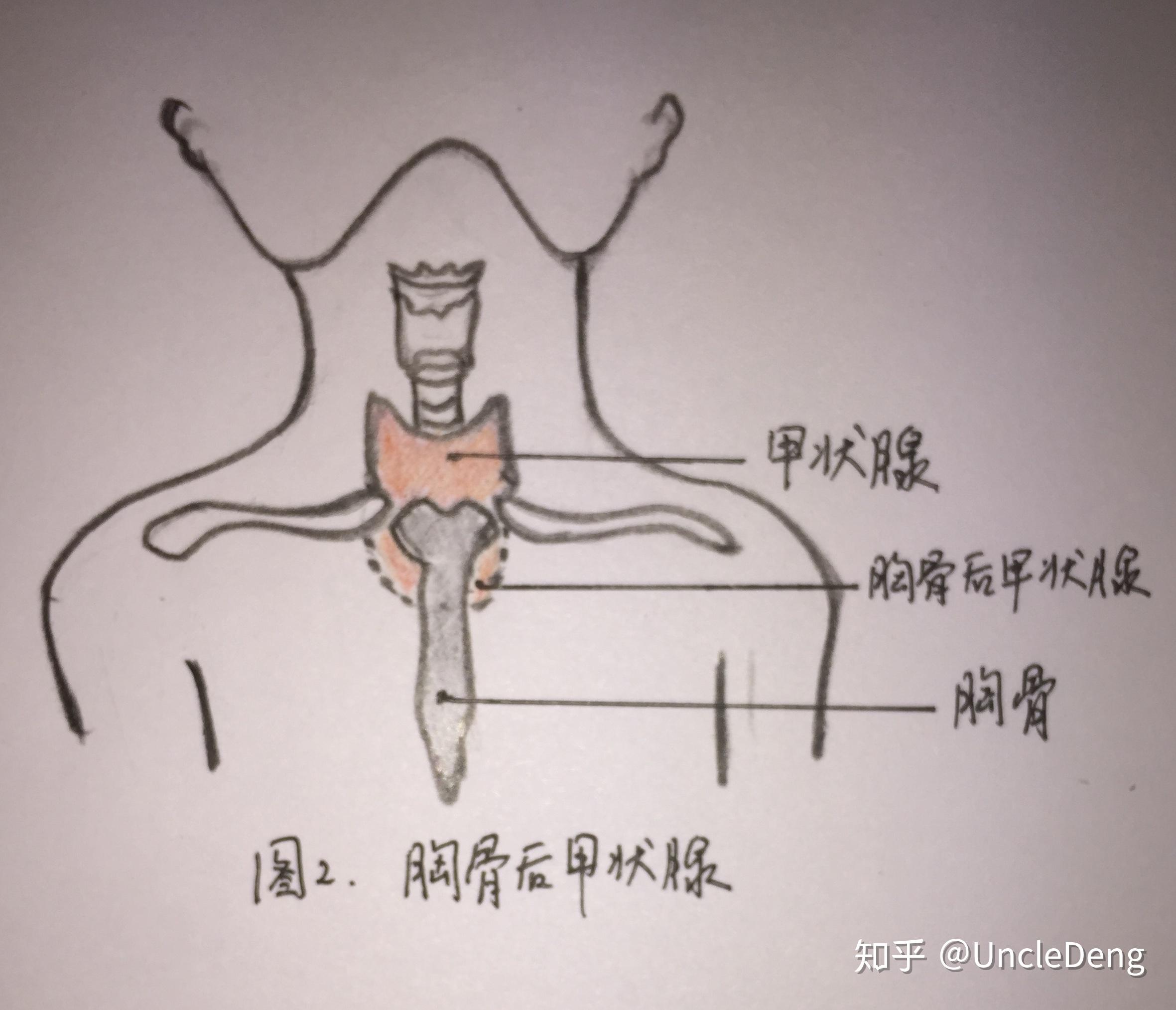 胸骨後甲狀腺腫瘤1例