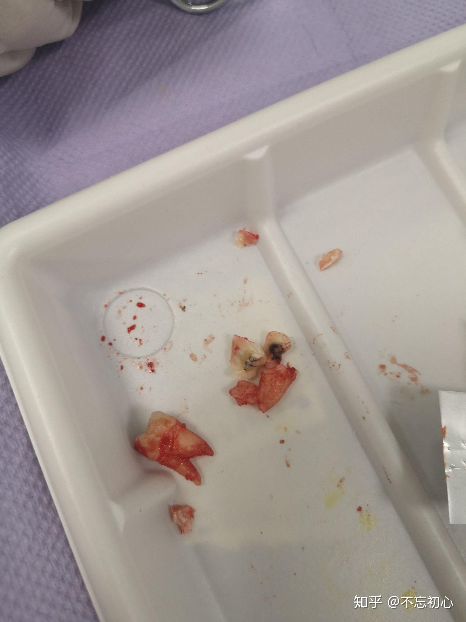 拔智齿和拔完智齿是怎样一种体验?