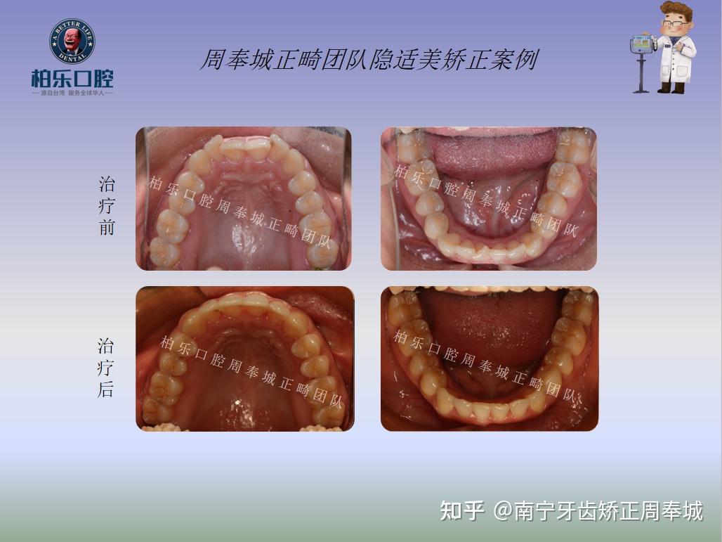 南寧牙齒矯正隱適美矯正案例牙齒不齊露齦笑