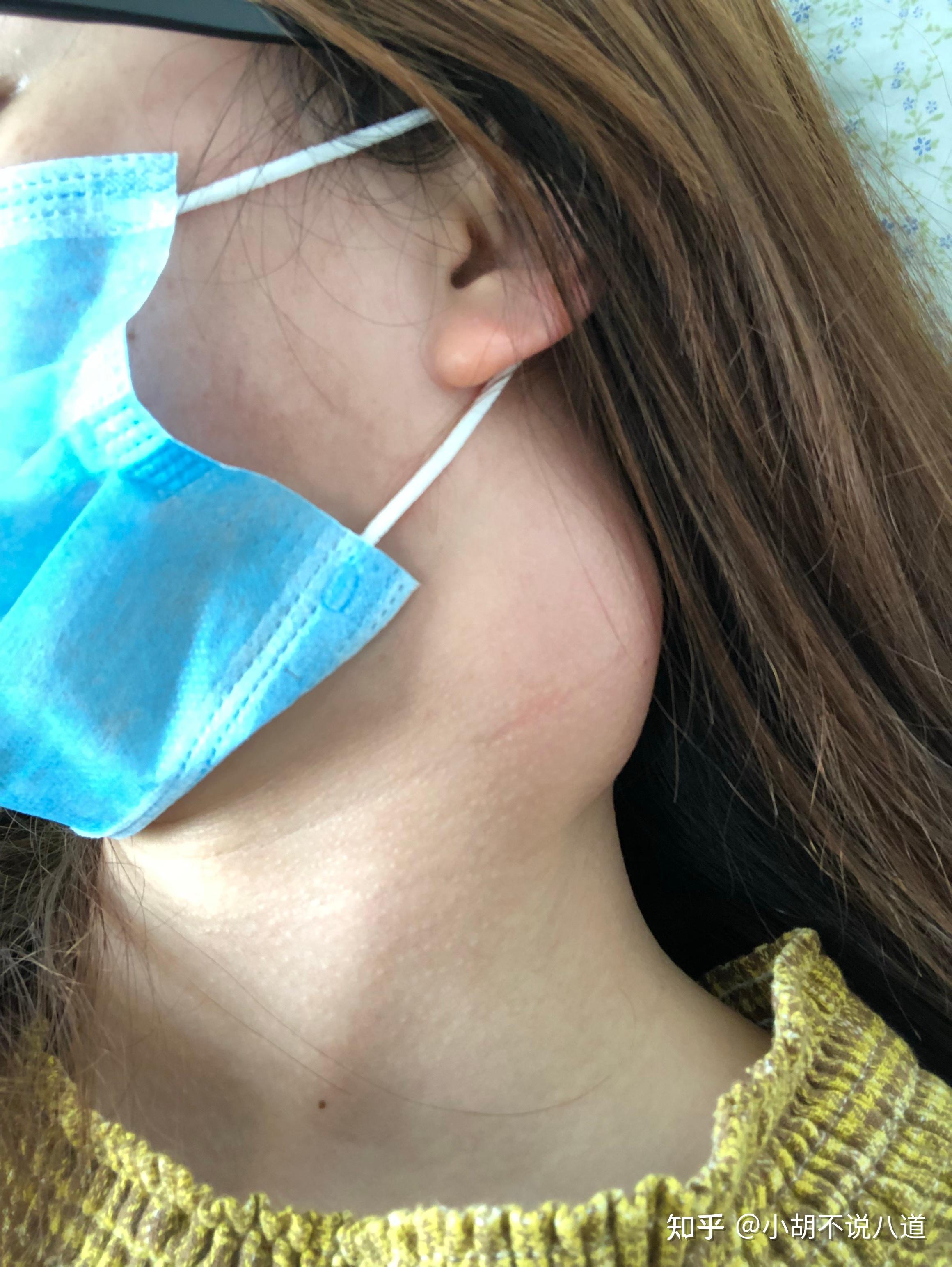 而实际上我颈部那个硬包是鼻咽癌转移到淋巴的恶性肿瘤,我在确诊