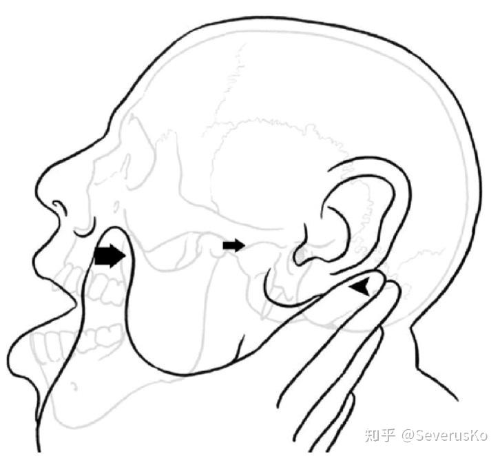 颞下颌关节脱位复位图图片