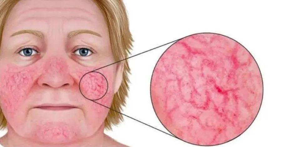 文献解读 | 水光注射氨甲环酸联合强脉冲光治疗红斑毛细血管扩张型玫