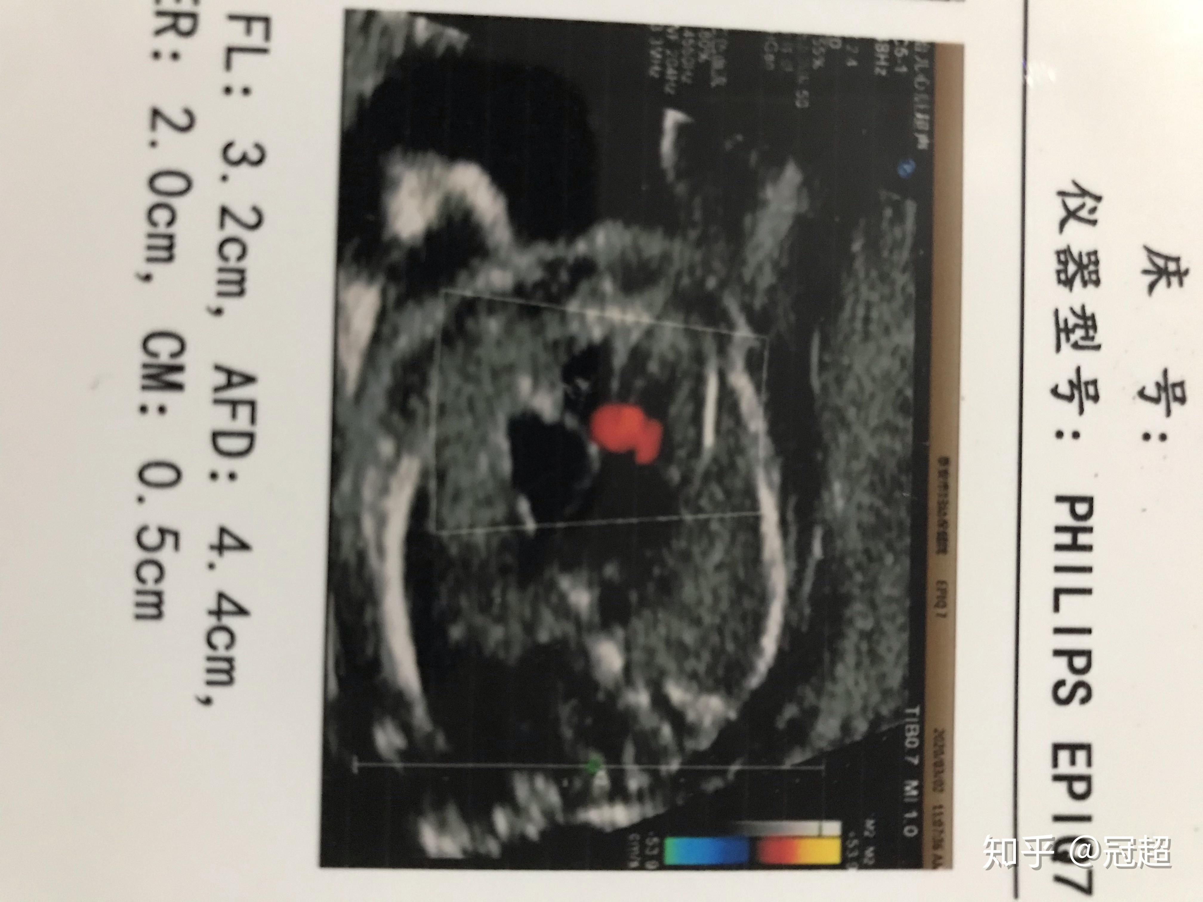 请各位专家帮我看一下怀孕19周5天的B超单子 双顶径4.5CM.胎心率148.腹围13.6CM.股 - 百度宝宝知道
