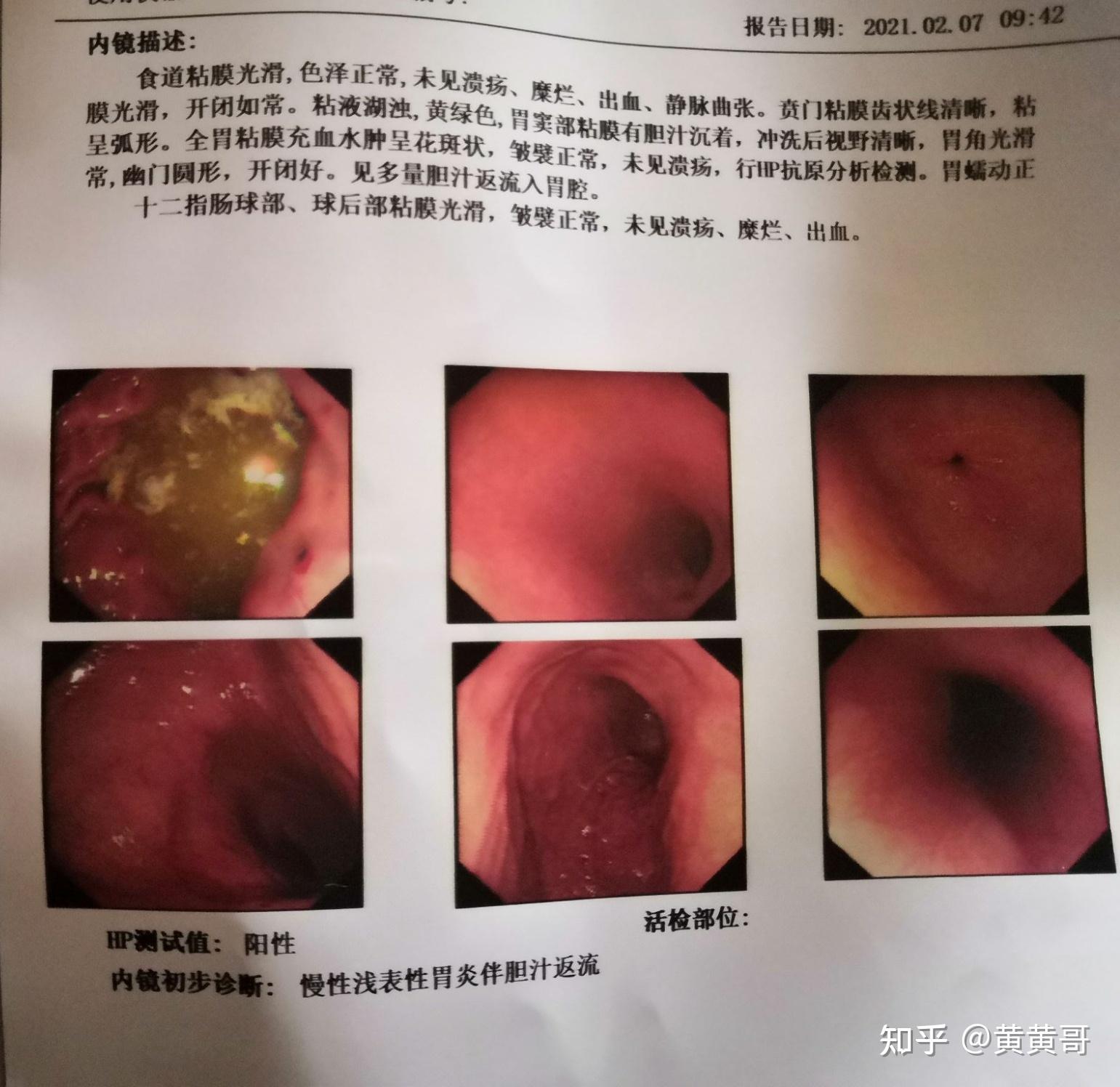 去医院做了胃镜,检查出幽门螺旋菌阳性 慢性胃炎 胆汁反流2.07