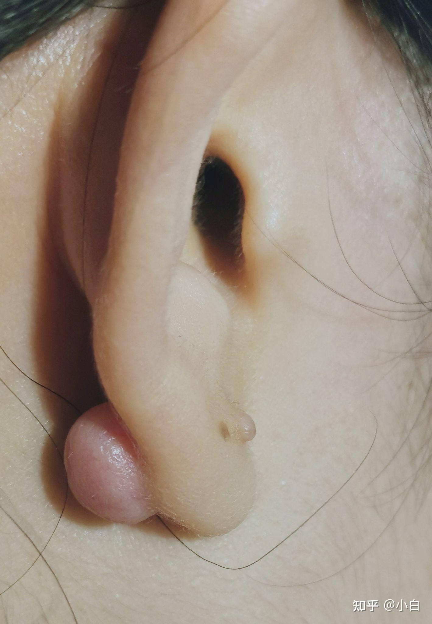 耳洞发炎红肿化脓艰辛恢复历程 - 知乎