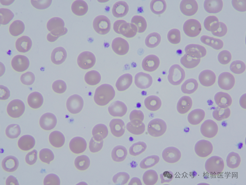 涂片瑞士吉姆萨染色,1000倍油镜下,结果如图5,镜下血小板增多,散在