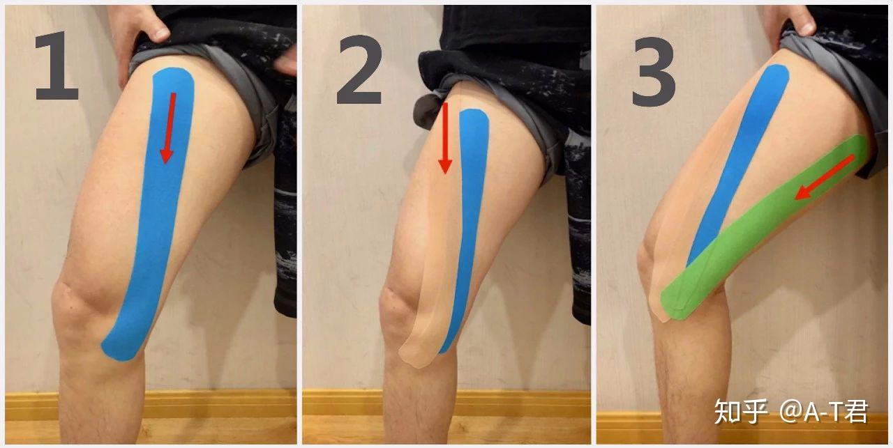 主要用于稳定髌骨,促进股四头肌发力;贴的过程要保持膝盖呈弯曲状态,y