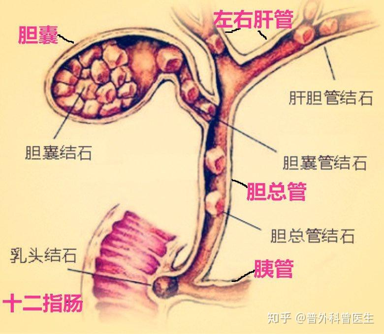 胆管结石常常是因为胆囊里面的结石掉到胆管里面了,引起胆管堵塞,患者