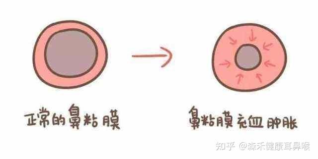 原来鼻黏膜是如此重要的存在